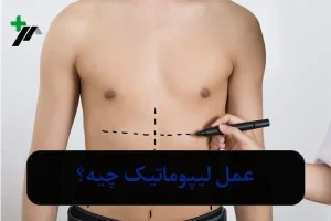 عمل لیپوماتیک